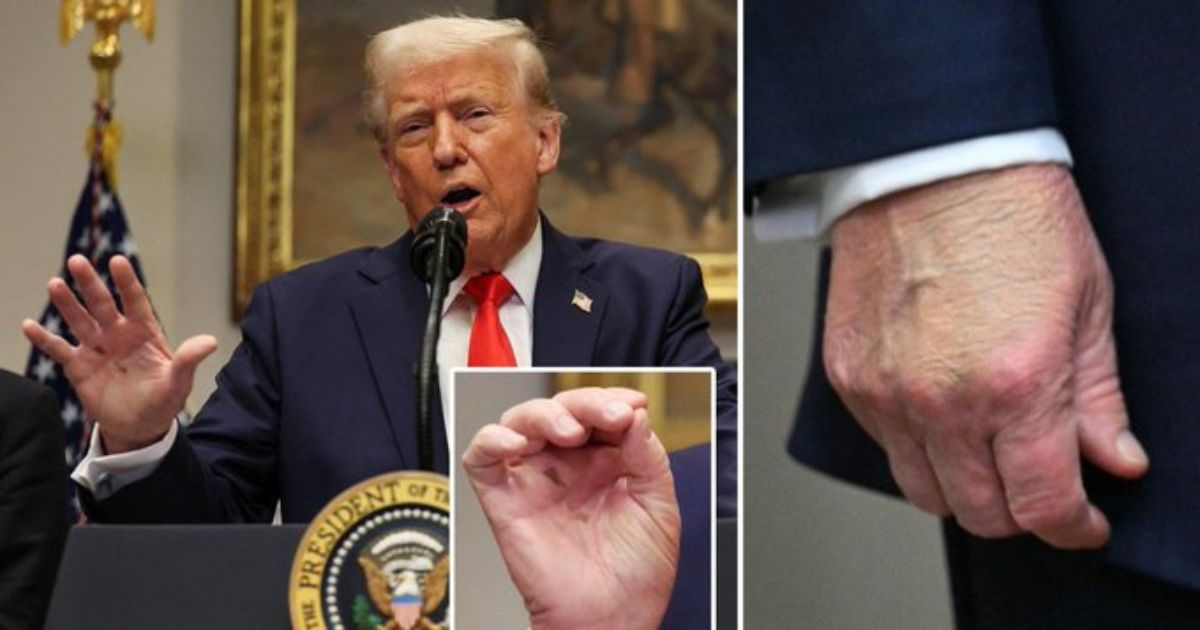 Donald Trump Hand Bruise