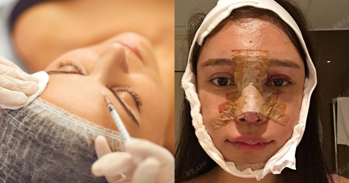 Abby Wu, a Chinese Influencer Went Through 100 Cosmetic Procedures to Change Her Appearance