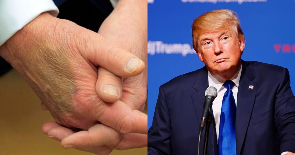 Image: Bruise on Donald Trump's hand (L) via Instagram @people, and President Donald Trump (R) via Wikimedia Commons (CC BY 2.0).