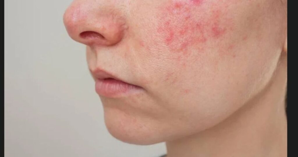 NASH and NAFLD Could Be Behind Persistent Facial Redness