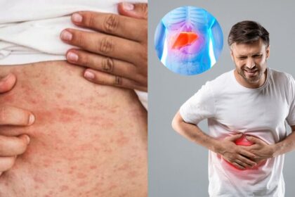 Toxic Liver Symptoms That Can Show Up On Your Skin