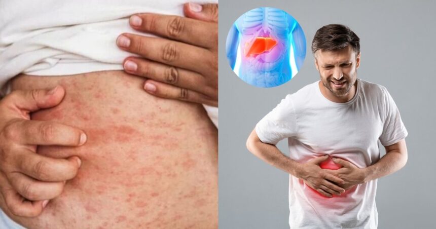 Toxic Liver Symptoms That Can Show Up On Your Skin