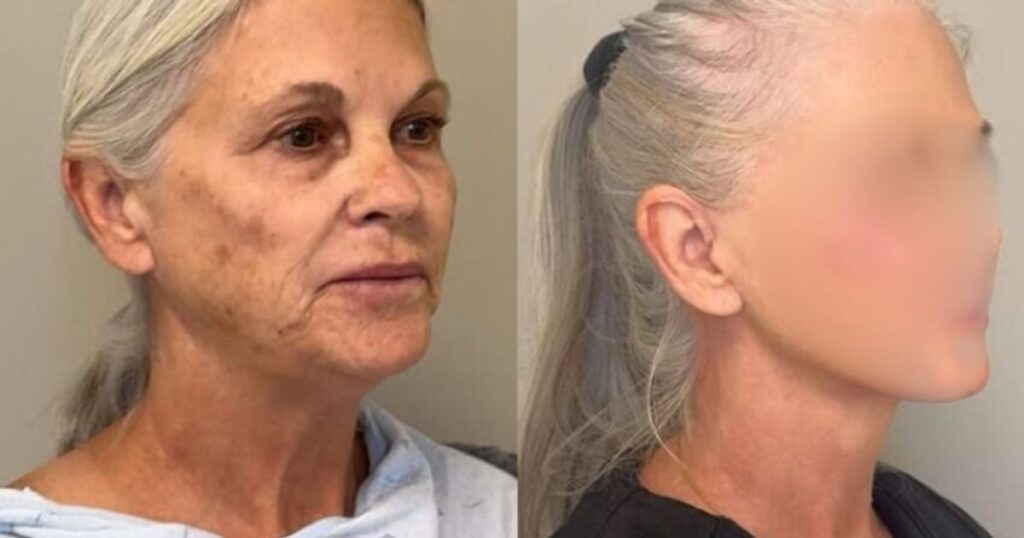 66-Year-Old Lisa VerMeer gets plastic surgery.
