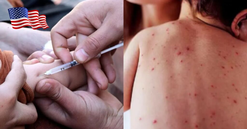 USA needs to prepare for the measles outbreak