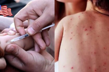 USA needs to prepare for the measles outbreak