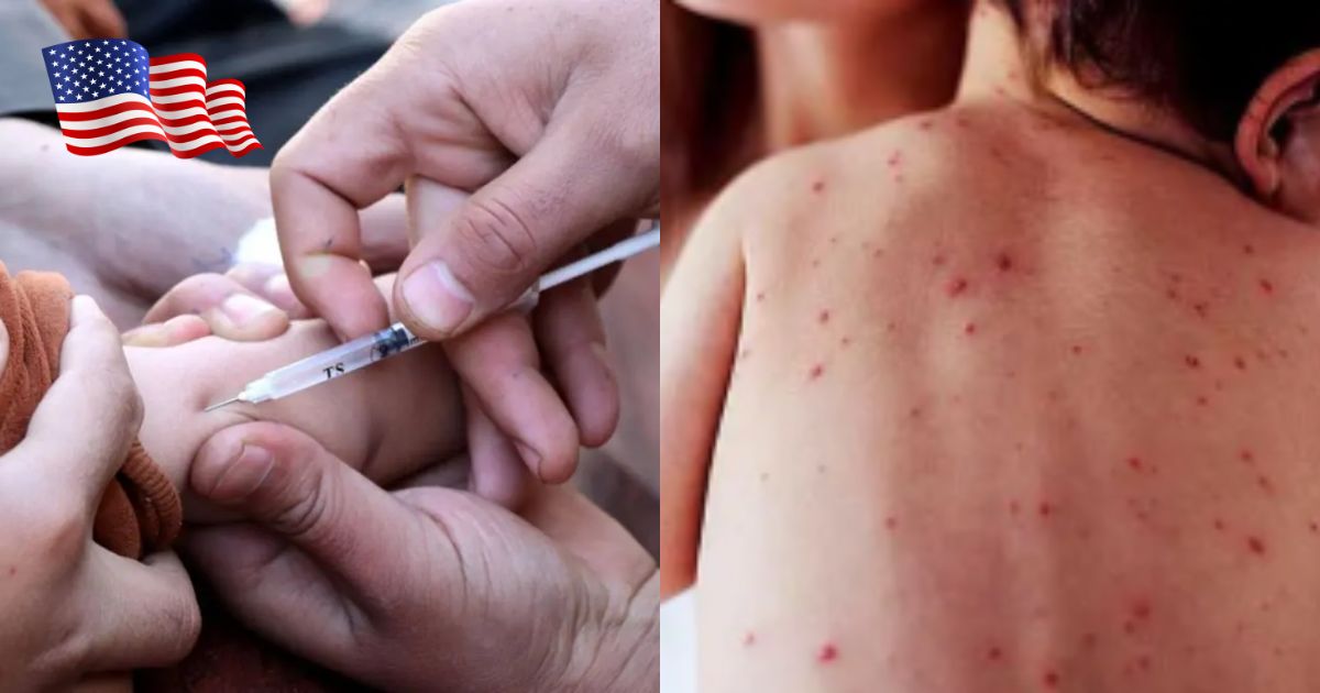 USA needs to prepare for the measles outbreak