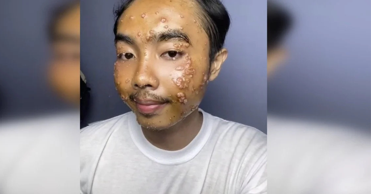 A tiktoker has contracted skin infection after wearing unwashed clothes