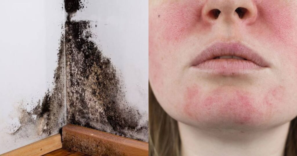 Uk woman has near death experience because of a mould infection