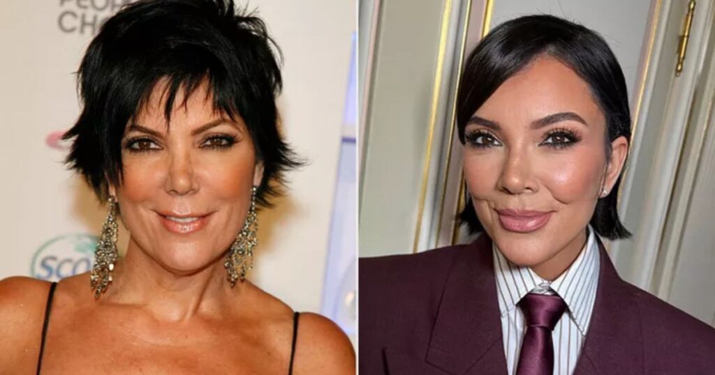 Kris Jenner's expensive, risky and rare facelift