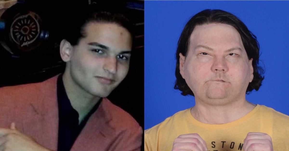 New Jersey teen undergoes face and hand transplant