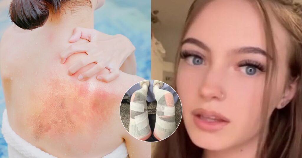 Woman suffers massive sunburn on a sunny day