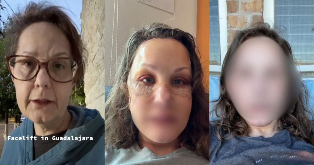 50-year-old's facelift transformation leaves netizens stunned.