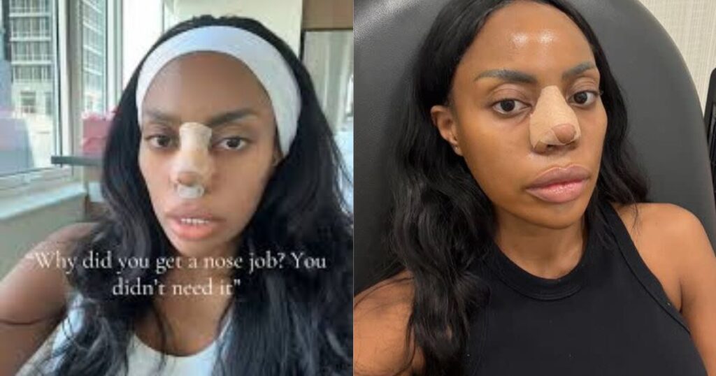 Zuri during her nose job process