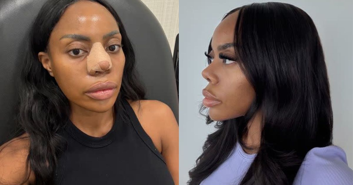 Zuri's Nose Job 'Deal' Has the Internet Talking
