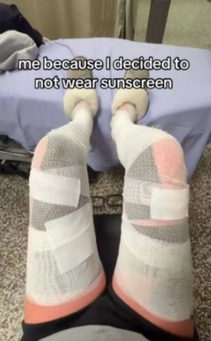 TikToker couldn't walk due to sunburn