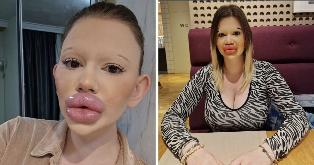 Andrea Ivanova has undergone 32 surgeries to get biggest lips in the world