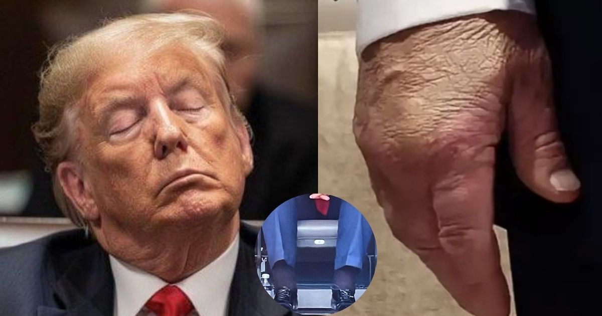 Donald Trump spotted with reportedly bruised hands and swollen ankles (left – @KwikWarren | X.com, right – @jacquie_rn | X, picture in the insert – @OKMagazine | X)