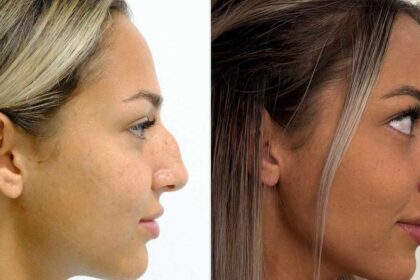 Texas woman gets nose surgery in Turkey