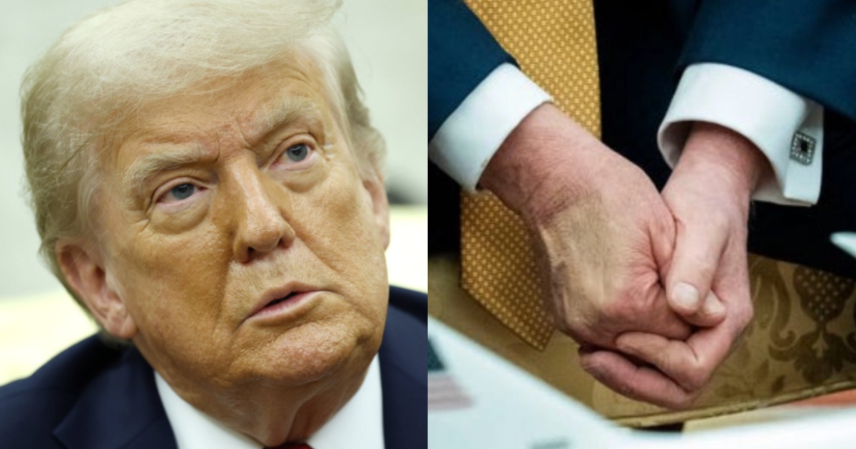 Donald Trump veins hand