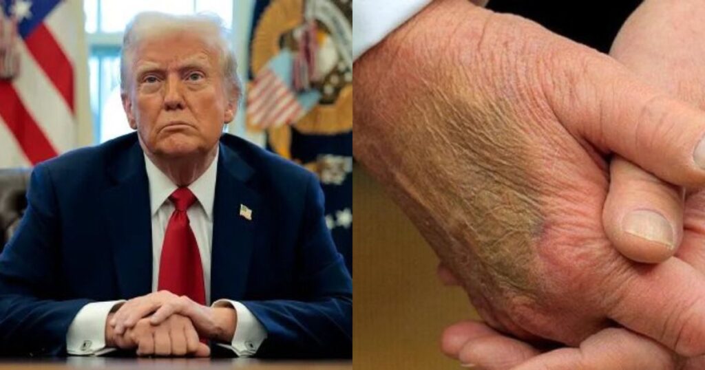 Trump’s Shaky Hands and Bruises Sparks Concern. (Cover image source: Twitter)