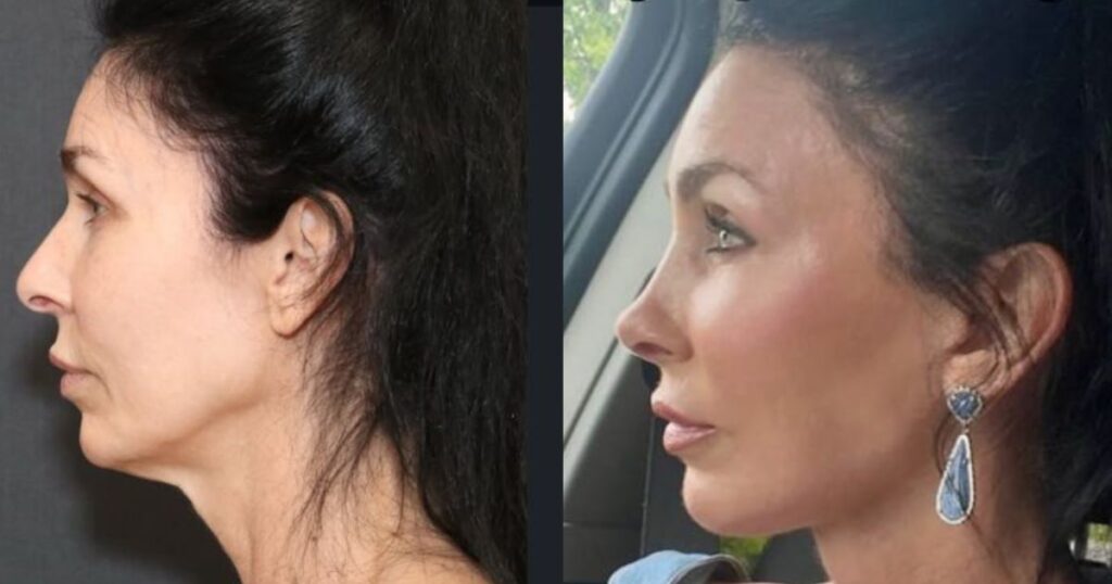 Woman's plastic surgery transformation leaves ChatGPT shocked