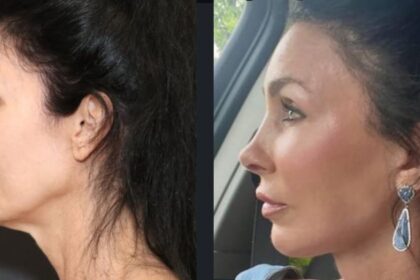 Woman's plastic surgery transformation leaves ChatGPT shocked