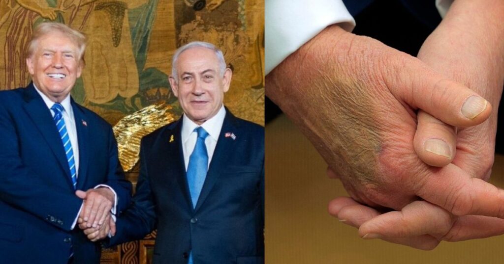 Donald trump's bruised hands