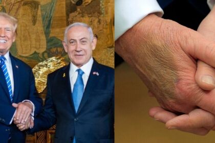 Donald trump's bruised hands