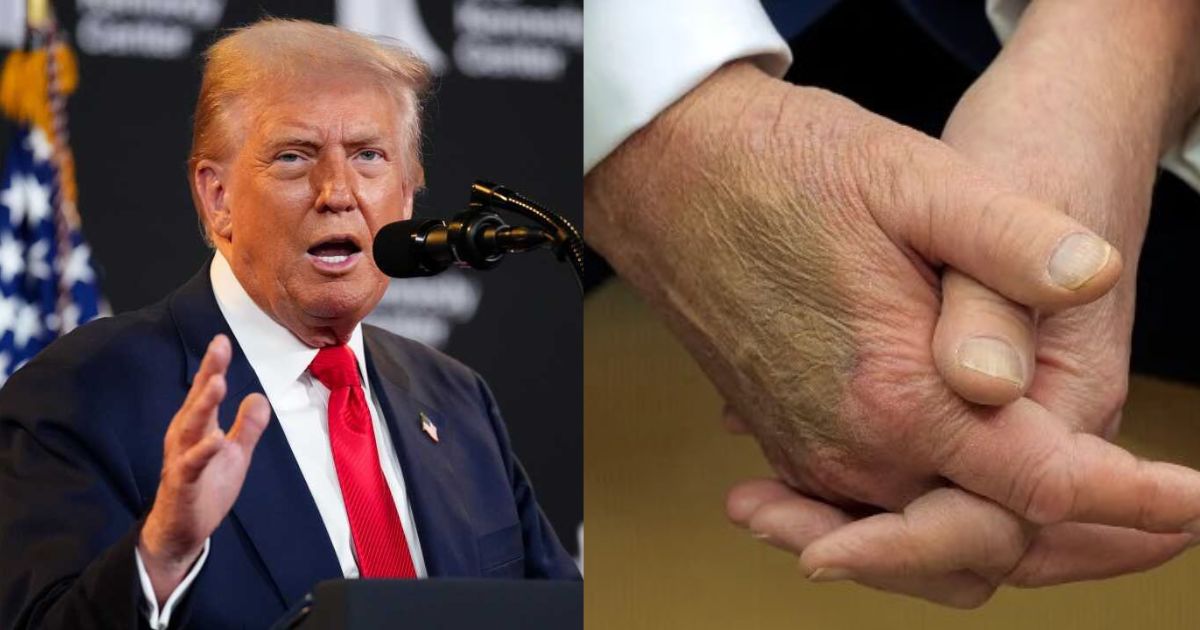 Donald Trump's hand bruise