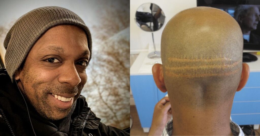 Brit man dies after going for hair transplant at a Turkey clinic