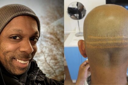 Brit man dies after going for hair transplant at a Turkey clinic