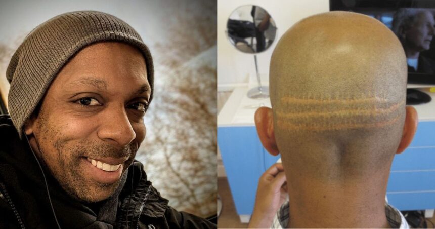 Brit man dies after going for hair transplant at a Turkey clinic