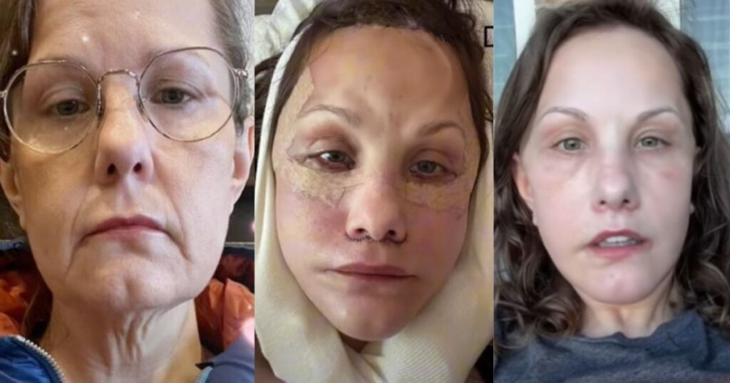 Michelle Wood's facelift journey
