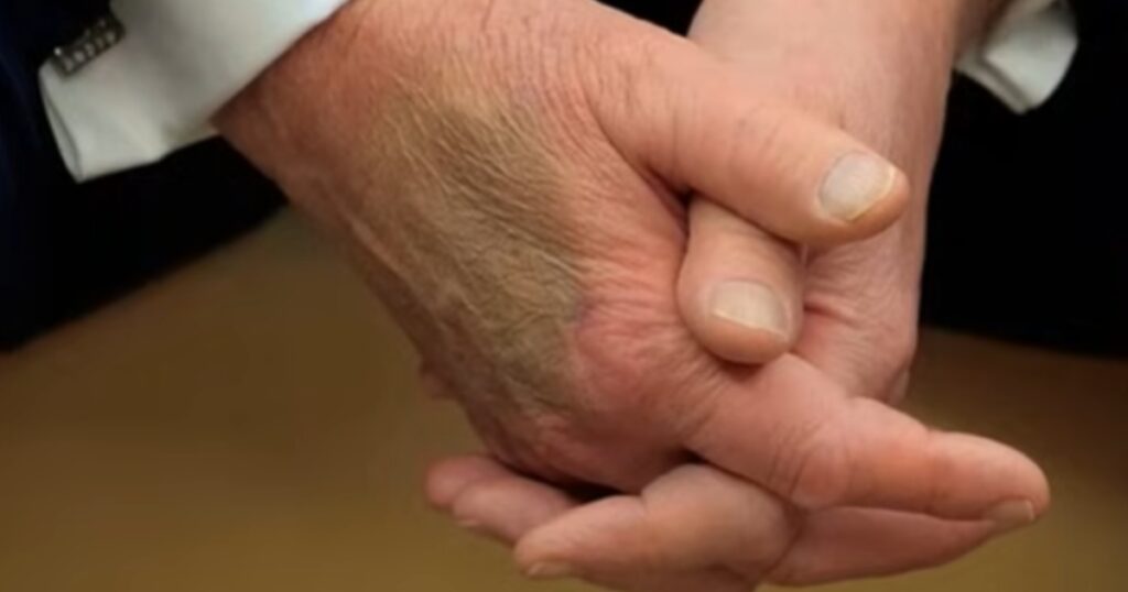 Trump hand bruises