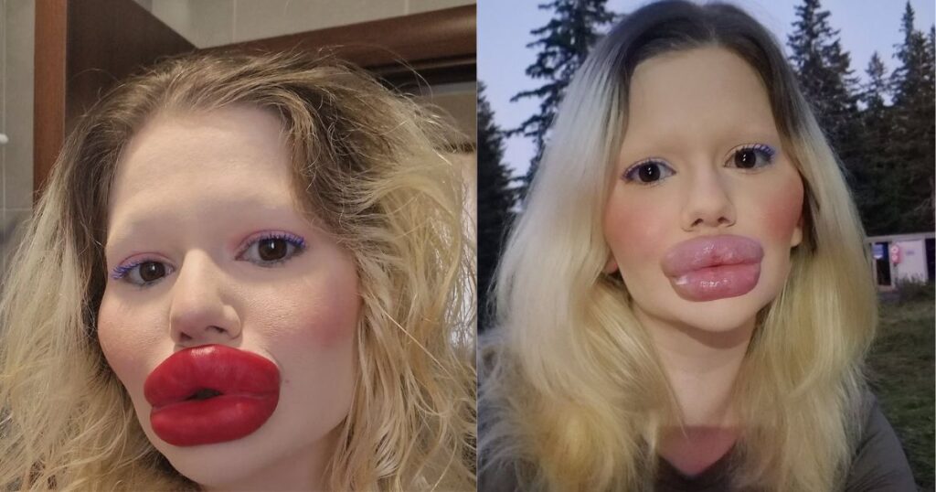 Andrea Ivanova, woman with the biggest lips, wants to have the biggest pout in the world.
