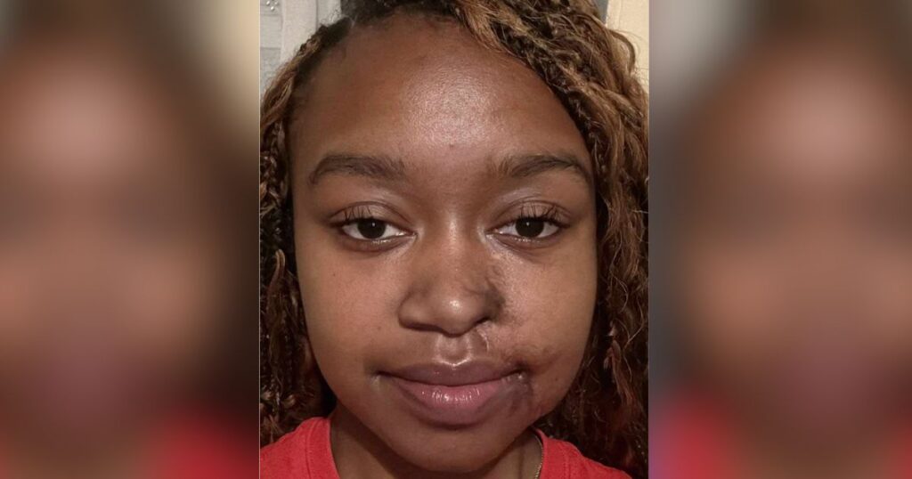 Acid attack survivor talk about plastic surgery