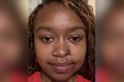 Acid attack survivor talk about plastic surgery