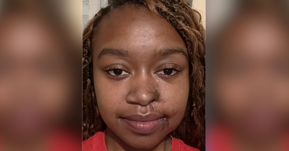 Doctor Helps Acid Attack Survivor With Free Plastic Surgery Her