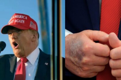 Donald Trump and his blue bruise ( left- AP-via FMT) and (right-blackinformationnetwork|Instagram).