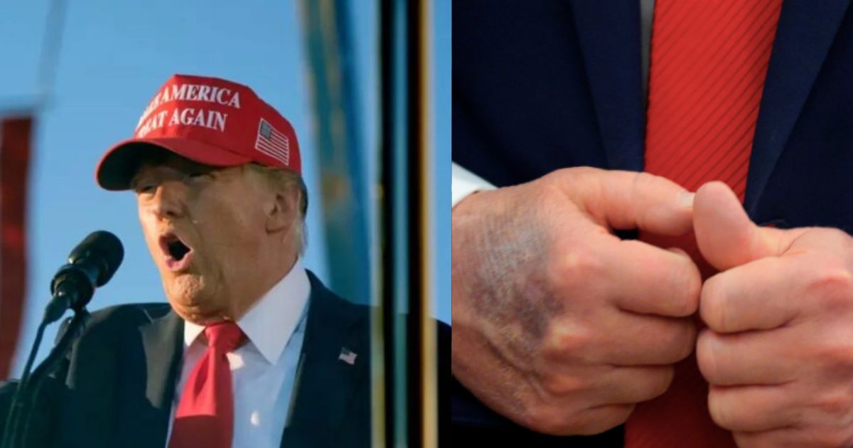 Donald Trump and his blue bruise ( left- AP-via FMT) and (right-blackinformationnetwork|Instagram).