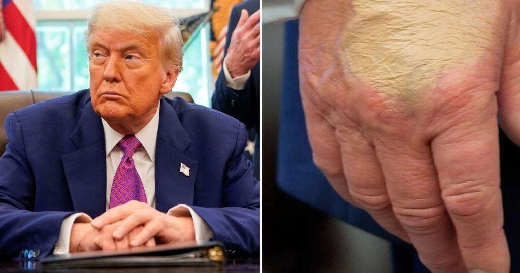 Makeup artist slams Donald Trump's Hand Bruise Cover-up
