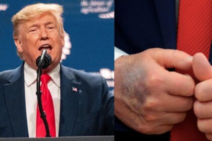 President Donald Trump with his bruises. (left- (picture via rawopixel) and ( (right- blackinformationnetwork|Instagram).