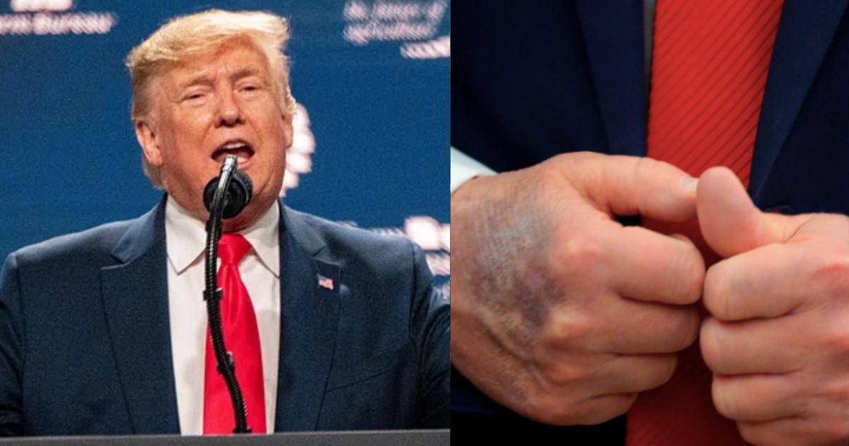 President Donald Trump with his bruises. (left- (picture via rawopixel) and ( (right- blackinformationnetwork|Instagram).