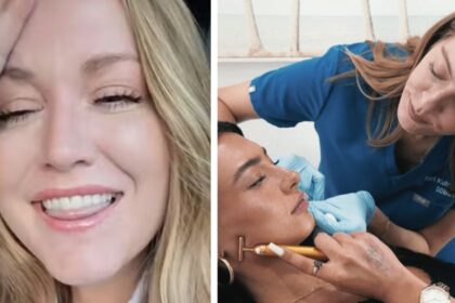 A women shared unexpected side effect of her trendy 'lip flip' cosmetic procedure on TikTok. (left- @samanthawlipedema/TikTok) and ( right- via sdbotox.com).