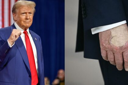 Donald Trump bruised hand