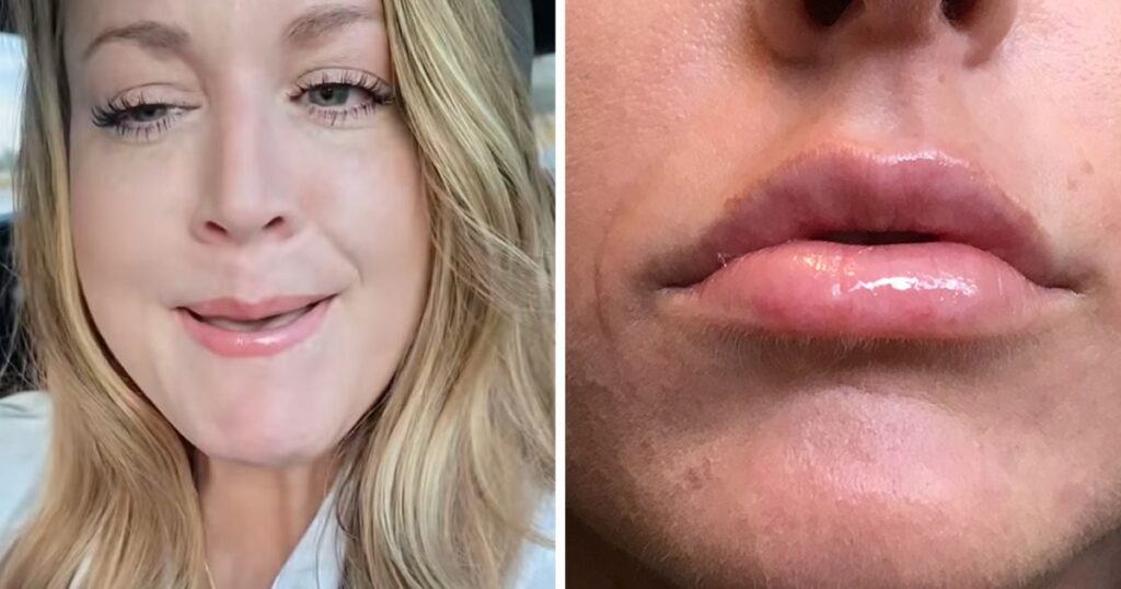 TikToker Samantha warns followers about the unexpected side effects of her recent lip flip