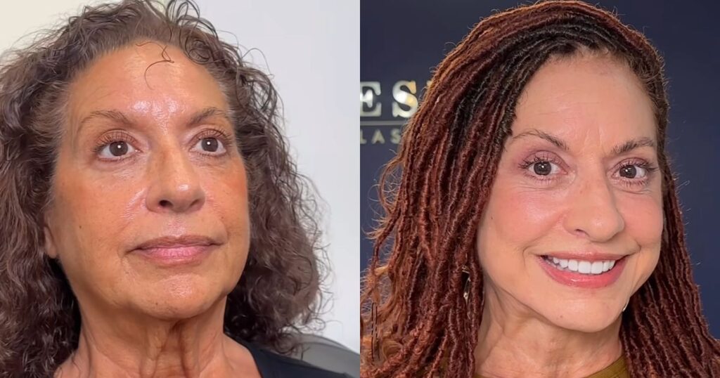 70-year-old woman goes through 8 plastic surgeries