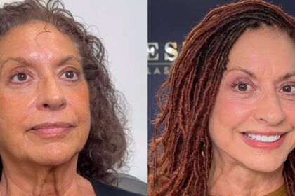 70-year-old woman goes through 8 plastic surgeries