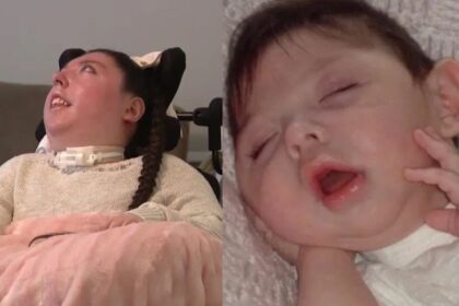 Alex Simpson turned 20 years old despite suffering from Hydranencephaly