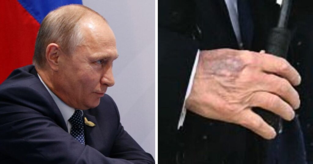 Vladimir Putin’s visibly swollen hand reignites global speculation over the Russian leader’s health
